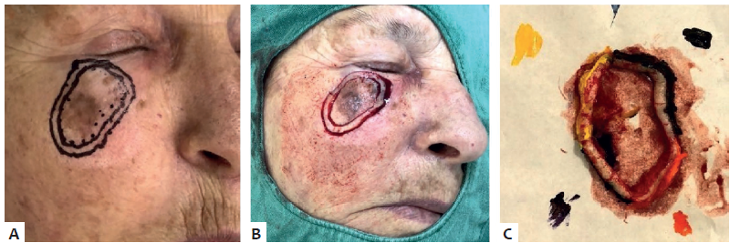 Primeiro est&aacute;gio cir&uacute;rgico: A - Marca&ccedil;&atilde;o da margem a ser
							excisada. B - Intraoperat&oacute;rio. C - Pe&ccedil;a
							encaminhada para an&aacute;lise histol&oacute;gica
