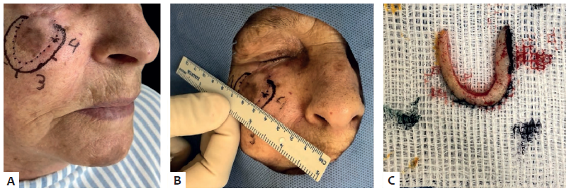 Segundo est&aacute;gio cir&uacute;rgico: A - Marca&ccedil;&atilde;o das margens
							comprometidas e Nicks com overlapping. B - Amplia&ccedil;&atilde;o de
							margem com faixa de pele de 5mm. C - Pe&ccedil;a encaminhada para
							an&aacute;lise histol&oacute;gica