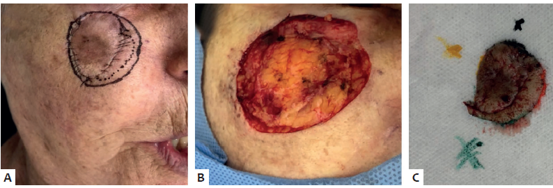Terceiro est&aacute;gio cir&uacute;rgico: A - Marca&ccedil;&atilde;o da margem
							comprometida e amplia&ccedil;&atilde;o. B - Defeito cir&uacute;rgico
								C - Pe&ccedil;a encaminhada para an&aacute;lise histol&oacute;gica