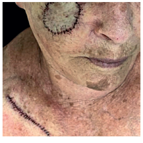 P&oacute;s-operat&oacute;rio imediato: reconstru&ccedil;&atilde;o com enxerto de pele
							total