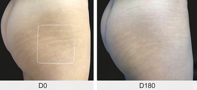 Imagem mostrando uma resposta excelente com microagulhamento + 5-FU