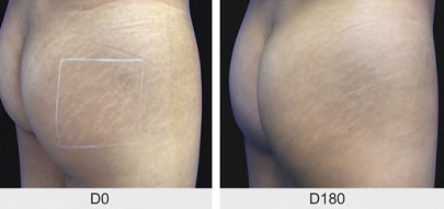 Imagem mostrando uma resposta boa com 5-FU intralesional