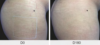 Imagem mostrando uma resposta muito boa com microagulhamento isolado