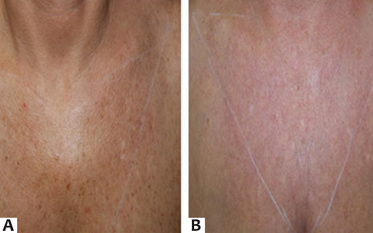 Área do colo em forma de triângulo invertido A - Antes (D0) e B - depois (D90) da aplicação do procedimento de microagulhamento