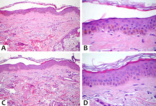 a - b: Biópsia pré-tratamento de uma paciente com fototipo II. Nessa imagem, a histologia mostra significativo número de melanócitos na camada basal da pele. Imagens foram coradas com Hematoxilina & eosina (magnificação original 40x); c-d: A análise histológica três meses após tratamento sugere redução do número de melanócitos com melhora da pigmentação da pele nas áreas tratadas com microagulhamento. A redução de melanina parece ser relativamente homogênea na extensão da epiderme avaliada (magnificação original 20x)
