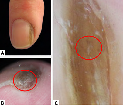 A: Vis&atilde;o cl&iacute;nica mostrando espessamento da placa ungueal com colora&ccedil;&atilde;o acastanhada. B: Dermatoscopia da borda livre onde &eacute; poss&iacute;vel ver pequenos orif&iacute;cios. C: Hemorragia em estilha&ccedil;o n&atilde;o observadas a olho nu