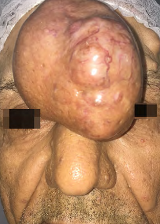 Tumora&ccedil;&atilde;o normocr&ocirc;mica em fronte, bem delimitada, com vasos na superf&iacute;cie. Observar nodula&ccedil;&atilde;o menor em fronte superior esquerda