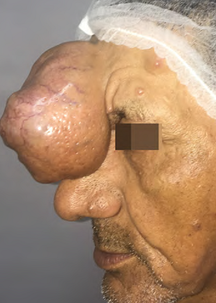 Vis&atilde;o lateral da tumora&ccedil;&atilde;o pedunculada em fronte