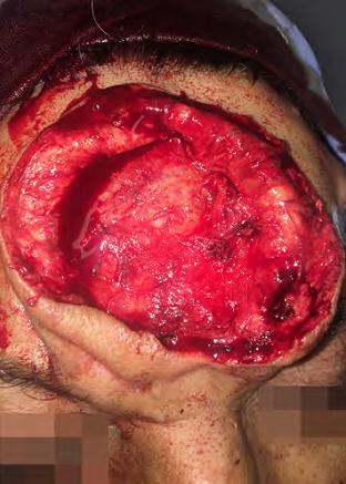 Imagem demonstrando o intraoperat&oacute;rio