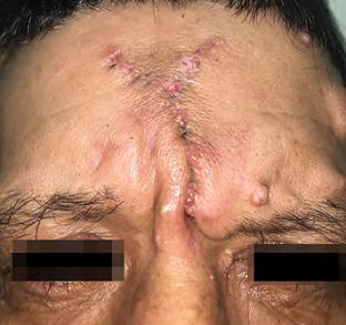 D&eacute;cimo dia de p&oacute;s-operat&oacute;rio