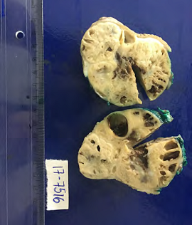 Pe&ccedil;a cir&uacute;rgica evidenciando tumor bem delimitado composto por &aacute;reas c&iacute;sticas em seu interior