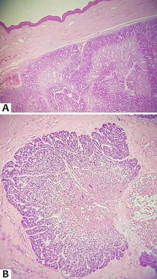 A - Exame anatomopatol&oacute;gico evidenciando foco de bloco basaloide lobulado comprimindo o tecido subcut&acirc;neo adjacente e formando uma pseudoc&aacute;psula B - Exame anatomopatol&oacute;gico evidenciando foco de bloco basaloide lobulado