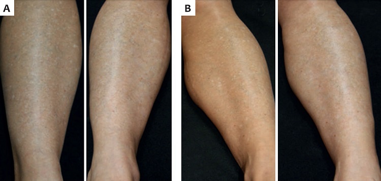 Paciente 1-A: perna direita antes e depois do Laser Er:YAG 2940nm e drugdelivery de piperina; B: perna esquerda antes e depois do Laser Er:YAG 2940nm 
