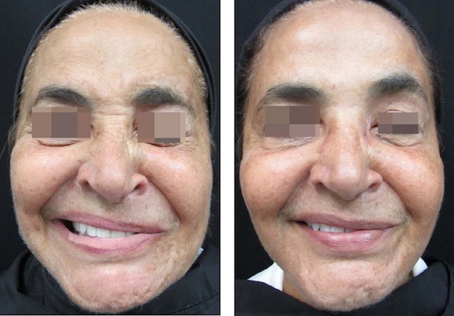 Sincinesia oro-ocular, com fechamento do olho esquerdo quando a paciente sorri, antes e depois da aplicação de toxina botulínica