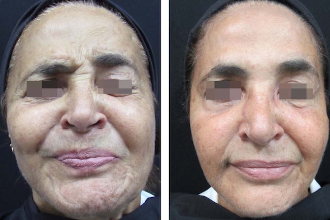 Fechamento do olho esquerdo quando a paciente recruta a musculatura da mímica facial do lado não acometido para contrair a fronte, antes e depois da aplicação de toxina botulínica