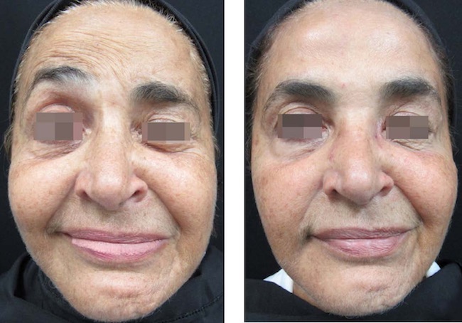 Fechamento do olho esquerdo quando a paciente recruta a musculatura da mímica facial do lado não acometido para elevar a fronte, antes e depois da aplicação de toxina botulínica