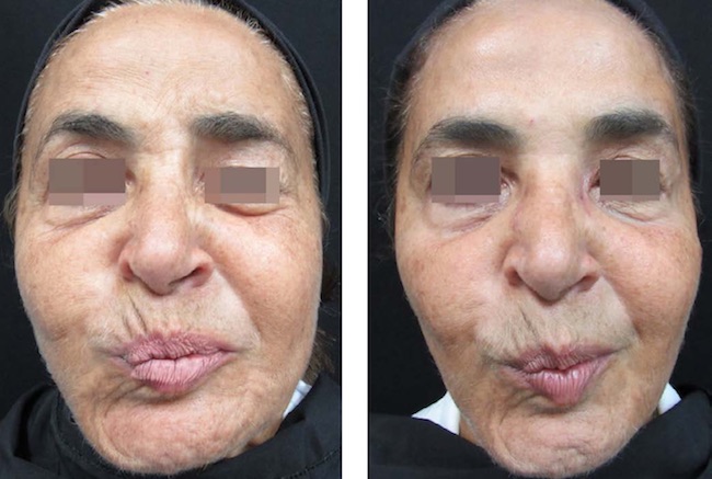 Fechamento do olho esquerdo quando a paciente recruta a musculatura da mímica facial do lado não acometido para o deslocamento lateral da cavidade oral, antes e depois da aplicação de toxina botulínica