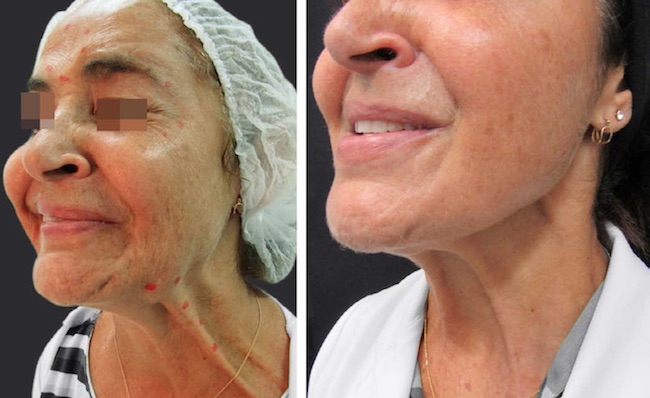 Pontos de aplicação de toxina botulínica no platisma com o intuito de aliviar espasmos