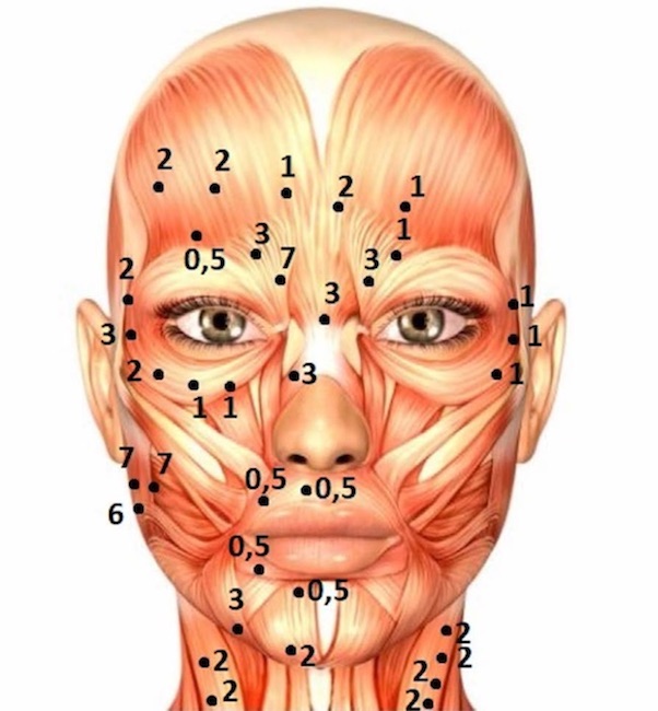 Esquema que mostra os pontos de aplicação de toxina botulínica na hemiface esquerda (acometida), no músculo orbicular do olho e platisma a fim de aliviar espasmos e corrigir sincinesia. Aplicação seletiva na hemiface direita (não acometida), na tentativa de melhorar a assimetria facial e corrigir algumas rugas