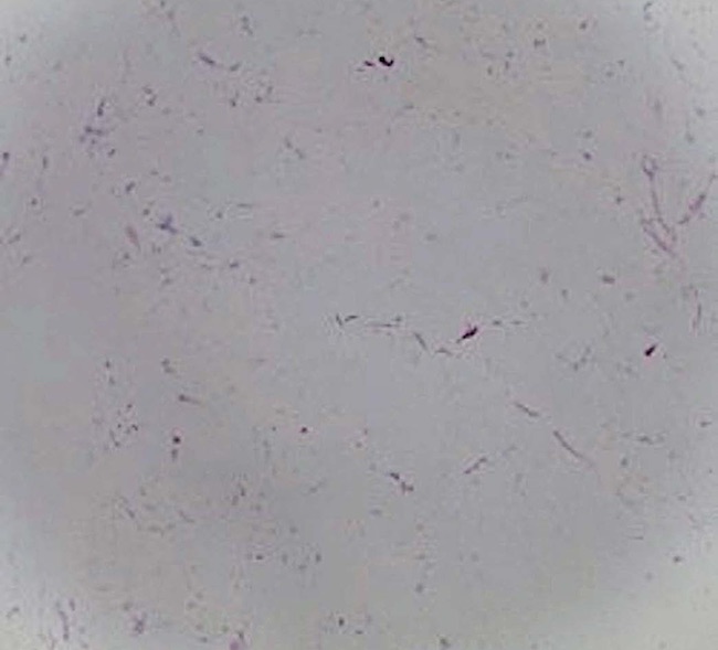 Tecido adiposo maduro entremeado por alguns capilares congestos, corroborando o diagn&oacute;stico de lipoma (Hematoxilina & eosina, 40x)