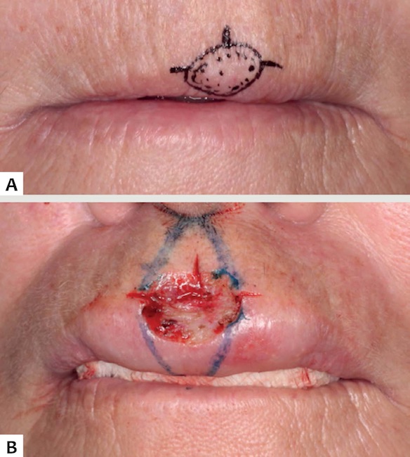 Caso 1 - 1A: Carcinoma basocelular demarcado em regi&atilde;o labial, acometendo l&aacute;bio cut&acirc;neo (incluindo filtro) e vermelh&atilde;o labial. 1B: Defeito cir&uacute;rgico final ap&oacute;s margens livres na CMM, com o desenho do duplo retalho em V-Y