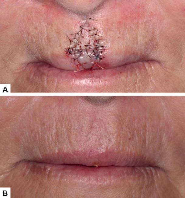 Caso 1 - 2A: Retalhos posicionados e suturados. 2B: Aspecto p&oacute;s-operat&oacute;rio de tr&ecirc;s meses