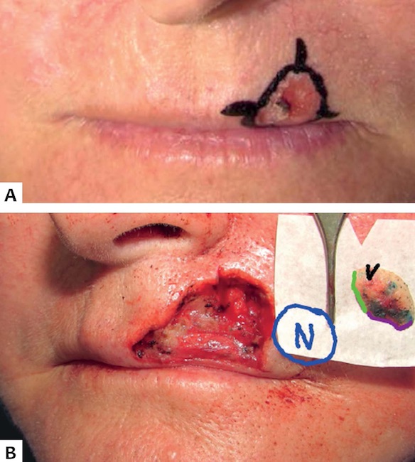 Caso 2 - 3A: Carcinoma basocelular em por&ccedil;&atilde;o esquerda do l&aacute;bio superior, acometendo l&aacute;bio cut&acirc;neo e vermelh&atilde;o. 3B: Defeito cir&uacute;rgico ap&oacute;s margens livres no terceiro est&aacute;gio da CMM