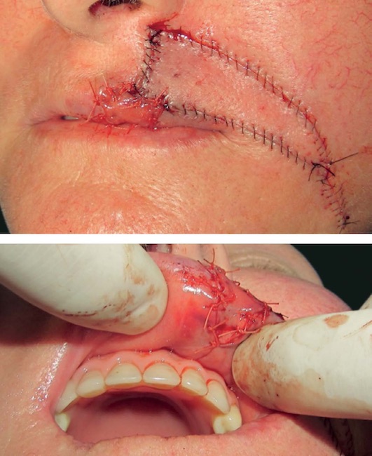 Caso 2 - Retalhos posicionados e suturados