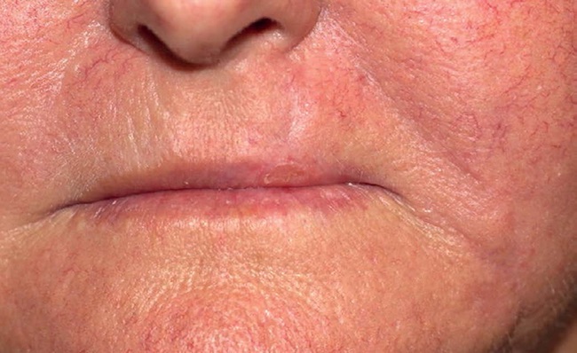 Caso 2 - Aspecto p&oacute;s-operat&oacute;rio de quatro meses