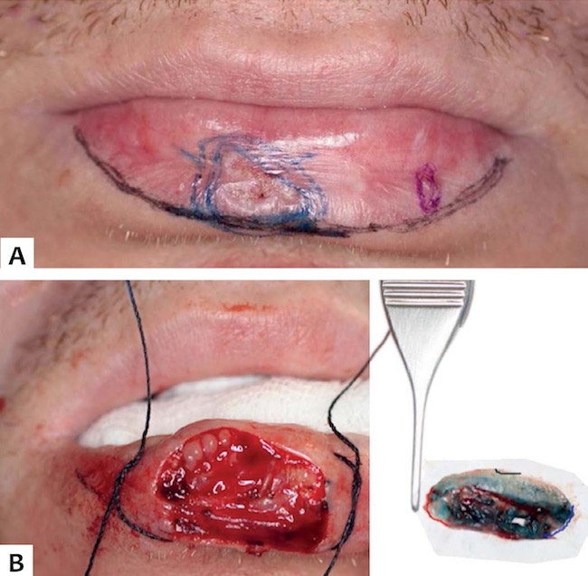 Caso 3 - A: Demarca&ccedil;&atilde;o da les&atilde;o em vermelh&atilde;o labial. B: Defeito cir&uacute;rgico ap&oacute;s margens livres na CMM