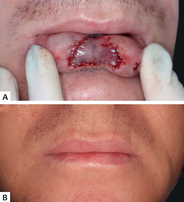 Caso 3 - A: Retalho de avan&ccedil;o V-Y de mucosa posicionado e suturado. B: Aspecto p&oacute;s-operat&oacute;rio de nove meses