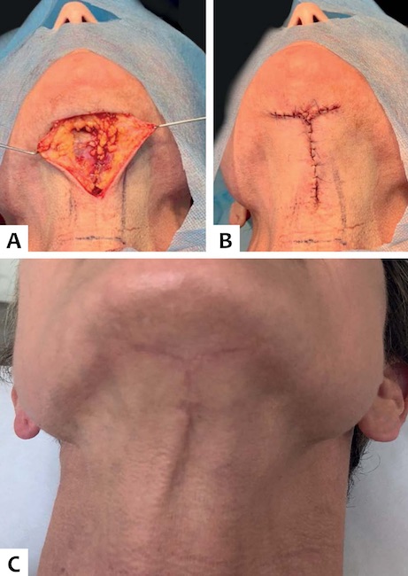 A.Exposi&ccedil;&atilde;o do m&uacute;sculo platisma ap&oacute;s excis&atilde;o direta de pele B. P&oacute;s-operat&oacute;rio imediato do lifting de pesco&ccedil;o com excis&atilde;o direta em &ldquo;T&rdquo;
