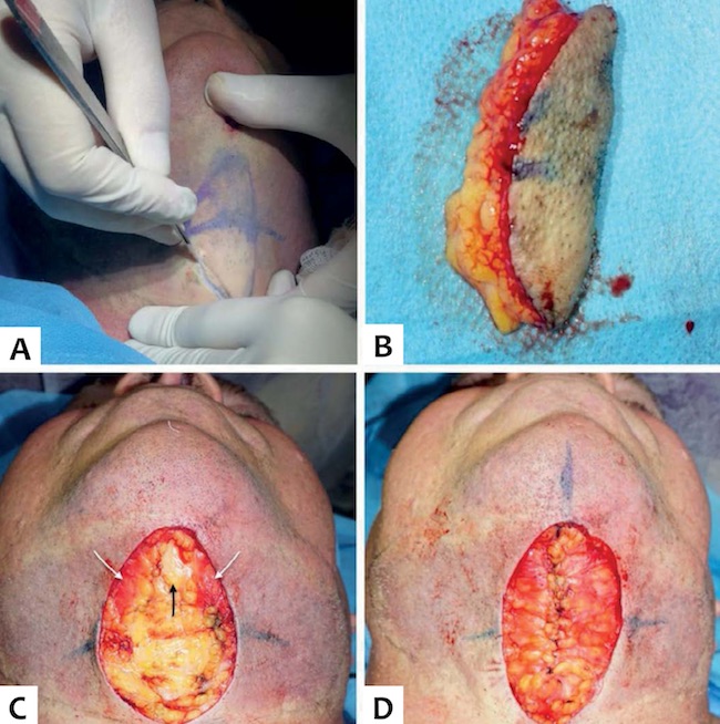 A.Incis&atilde;o at&eacute; o n&iacute;vel do m&uacute;sculo platisma. B. Esp&eacute;cime de pele e gordura pr&eacute;-platismal removidos em bloco. C. Defeito cir&uacute;rgico ap&oacute;s excis&atilde;o. Nota-se decussa&ccedil;&atilde;o das fibras anteriores do m&uacute;sculo platisma (setas brancas) e exposi&ccedil;&atilde;o da gordura subplatismal (seta preta). D. Platismoplastia: sutura cont&iacute;nua das bordas mediais do m&uacute;sculo com fio mononylon 3-0