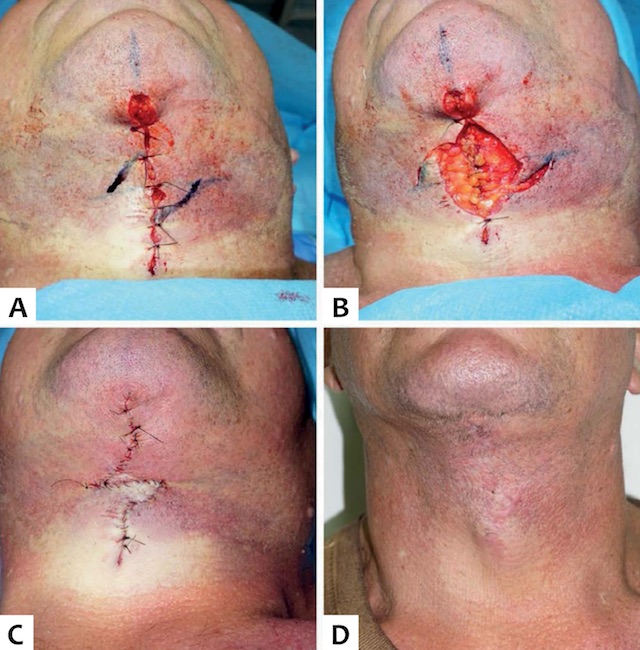 A. Suturas tempor&aacute;rias com pontos simples e marca&ccedil;&atilde;o dos dois ramos da zetaplastia a 60 graus do &acirc;ngulo cervicomentoniano/linha cervical. B. As incis&otilde;es da zetaplastia ap&oacute;s a remo&ccedil;&atilde;o das suturas tempor&aacute;rias. C. P&oacute;s-operat&oacute;rio imediato: transposi&ccedil;&atilde;o dos ramos da zetaplastia e sutura cont&iacute;nua. D. P&oacute;s-operat&oacute;rio de tr&ecirc;s meses com cicatriz em &ldquo;Z&rdquo; pouco vis&iacute;vel