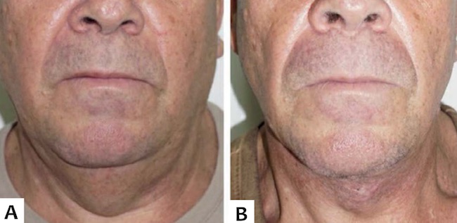 A. Pr&eacute;-operat&oacute;rio, masculino, 53 anos, com excesso de pele e gordura cervical, vis&atilde;o frontal. B. P&oacute;s-operat&oacute;rio de tr&ecirc;s meses ap&oacute;s lifting de pesco&ccedil;o com excis&atilde;o direta, zetaplastia, platismoplastia e lipoaspira&ccedil;&atilde;o de submento
