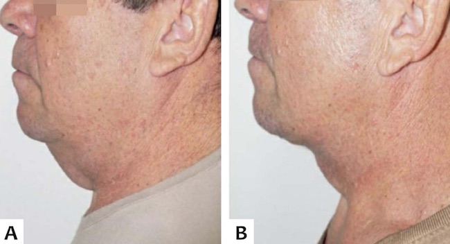 A. Pr&eacute; e B. P&oacute;s-operat&oacute;rio de tr&ecirc;s meses, vis&atilde;o lateral esquerda