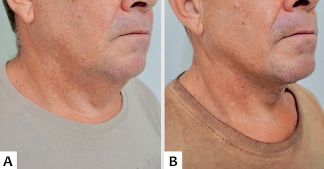 A.Pr&eacute; e B. P&oacute;s-operat&oacute;rio de tr&ecirc;s meses, vis&atilde;o obl&iacute;qua direita