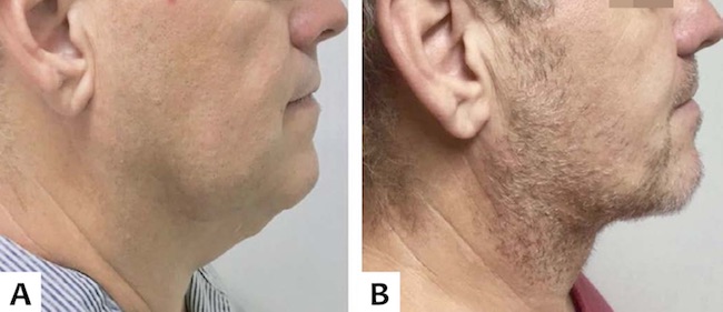 A. Pr&eacute; e B. P&oacute;s-operat&oacute;rio de um m&ecirc;s de paciente masculino, 45 anos, com excesso de pele cervical, vis&atilde;o lateral direita