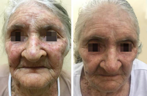 A. pré tratamento; B. pós tratamento