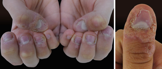 Aspecto clínico na primeira consulta. A - Visão geral do acometimento das verrugas periungueais dos dedos de ambas as mãos. B - Aspecto do polegar direito, dedo mais acometido