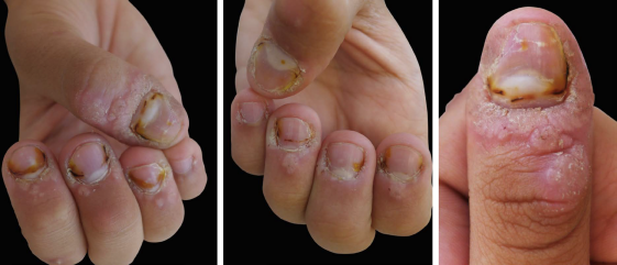 Aspecto clínico após quatro sessões de quimiocauterização com ácido fênico 88% e ácido nítrico fumegante associado a aplicações diárias de solução de ácido salicílico 16,5% e ácido lático 14,5%, oito semanas após a primeira consulta. A e B - Visão geral do acometimento das verrugas periungueais dos dedos de ambas as mãos. C - Aspecto do polegar direito, dedo mais acometido