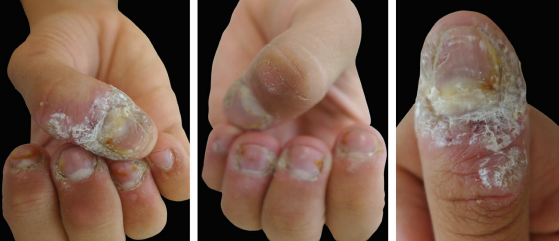 Aspecto clínico após duas sessões de quimiocauterização com ácido tricloroacético a 35% associado a aplicações diárias de solução de ácido salicílico 16,5% e ácido lático 14,5%, dez semanas após a primeira consulta. A e B - Visão geral do acometimento das verrugas periungueais dos dedos de ambas as mãos. C - Aspecto do polegar direito, dedo mais acometido