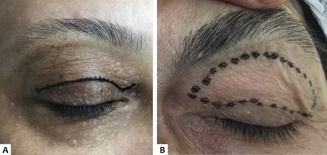 A. Marca&ccedil;&atilde;o da linha de incis&atilde;o sobre o sulco supratarsal. B. Marca&ccedil;&atilde;o da incis&atilde;o, demonstrando os limites superior, inferior, lateral, medial, e a pele com elastose