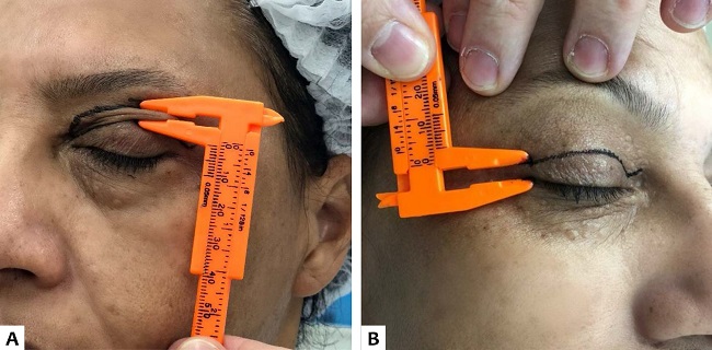 A. Plicatura mostrando n&atilde;o prejudicar o fechamento da rima ocular. B. Marca&ccedil;&atilde;o com no m&iacute;nimo 4mm acima da borda ciliar para n&atilde;o impedir a drenagem linf&aacute;tica