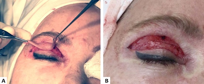 A. Dissec&ccedil;&atilde;o da pele com aux&iacute;lio do gancho de Gilles. B. M&uacute;sculo orbicular ap&oacute;s remo&ccedil;&atilde;o total da pele