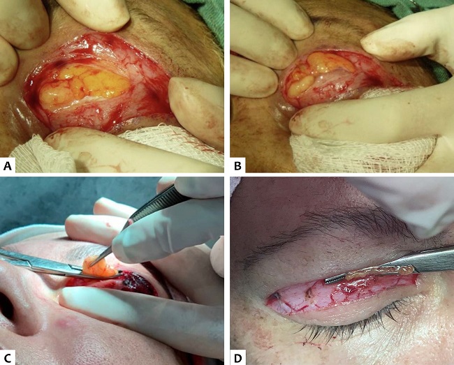 A. Bolsa mediana ou central. B. Leve press&atilde;o no globo ocular, facilitando a exposi&ccedil;&atilde;o da bolsa adiposa. C. Bolsa de gordura clampeada pela pin&ccedil;a Kelly. D. Pin&ccedil;a Kelly fechada com o ped&iacute;culo da bolsa de gordura entre as suas serrilhas