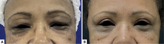 A. Paciente em pr&eacute;-operat&oacute;rio de blefaroplastia superior. B. Paciente ap&oacute;s blefaroplastia superior