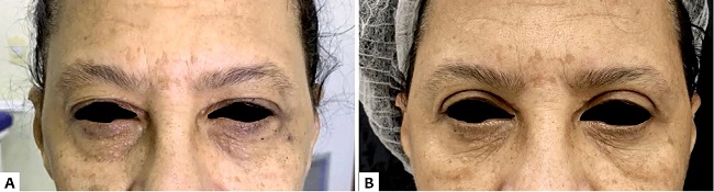 A. Paciente em pr&eacute;-operat&oacute;rio de blefaroplastia superior. B. Paciente ap&oacute;s blefaroplastia superior