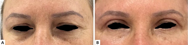 A. Paciente em pr&eacute;-operat&oacute;rio de blefaroplastia superior. B. Paciente ap&oacute;s blefaroplastia superior