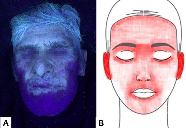 Representa&ccedil;&atilde;o da cobertura facial pelo filtro solar sob a luz de Wood. (A) Exemplo de uma aplica&ccedil;&atilde;o heterog&ecirc;nea do filtro solar, negligenciando o l&aacute;bio superior, regi&atilde;o nasal e fronte. (B) Diagrama t&eacute;rmico das regi&otilde;es da face com menor cobertura pelo filtro solar, sendo que as &aacute;reas escuras indicam as &aacute;reas menos cobertas (n = 40)